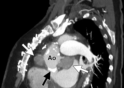 Perigraft pseudoaneurysms in a 71-year-old woman with a prosthetic aortic valve. Sagittal oblique (b) maximum intensity projection CT images show two contained collections (white arrows) associated wi